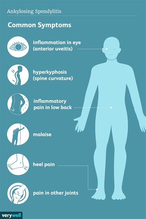 Ankylosing Spondylitis: Signs, Symptoms, and Complications