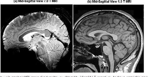 Figure 4 from New brain atlas - Mapping the human brain in vivo with 7. ...