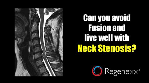 Living With Cervical Spinal Stenosis: My Story - Regenexx