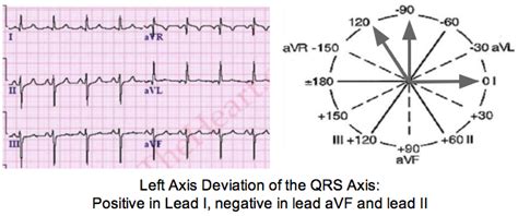 Determine Axis on a 12-lead ECG Tracing | LearntheHeart.com