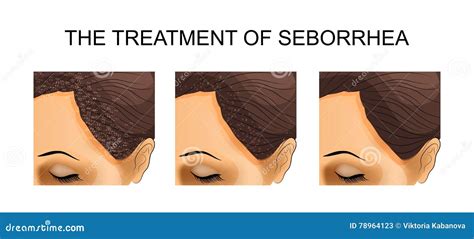 The Treatment of Seborrhea. before and after Stock Vector ...