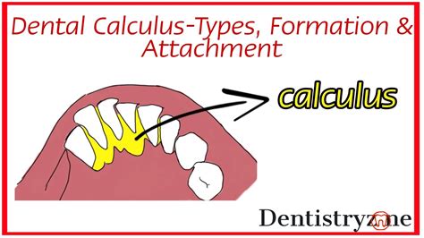 Dental calculus- Types, Formation & Attachment | Periodontology | Dentistry.