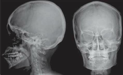 Normal Skull X Ray