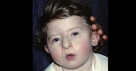 DiGeorge syndrome: symptoms, causes and treatment