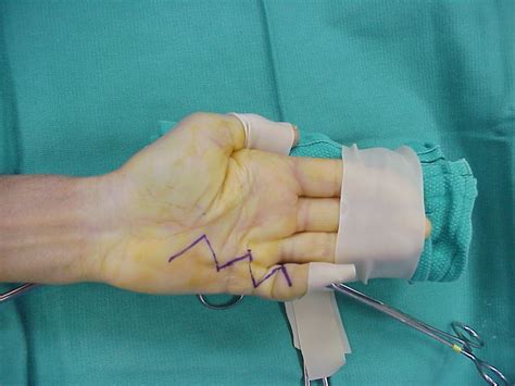 Dupuytren's: Swan Neck Deformity after Palmar Fasciectomy for Dupuytren's Contracture