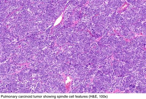 Pathology Outlines - Typical carcinoid tumor / neuroendocrine tumor, grade 1