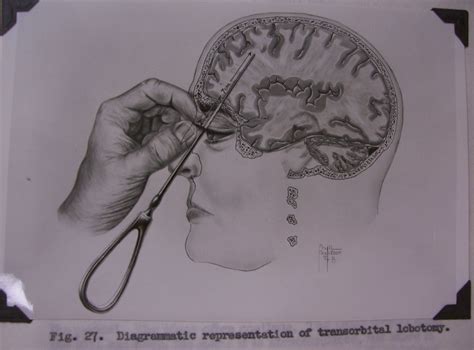 Frequently asked questions about lobotomy – Miriam Posner's Blog