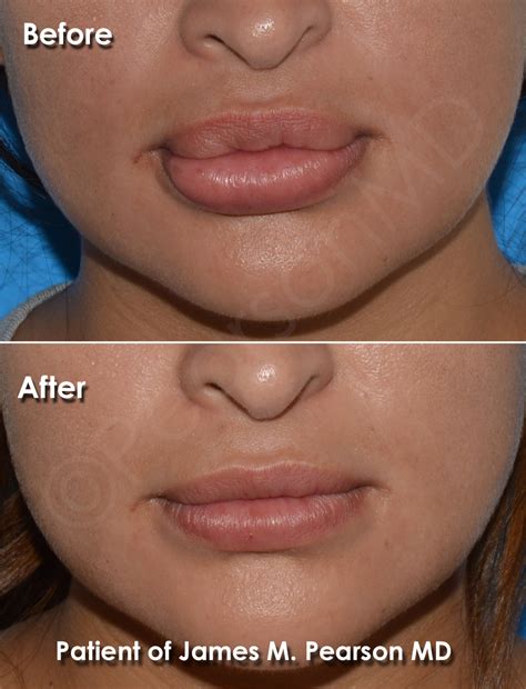 Lip Reduction Photos - Before & After - Dr. James Pearson Facial Plastic Surgery