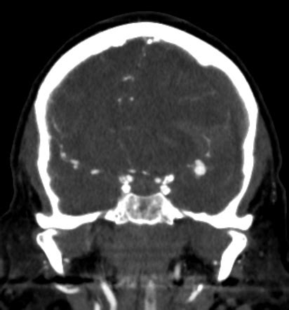 Middle cerebral artery aneurysm rupture | Image | Radiopaedia.org