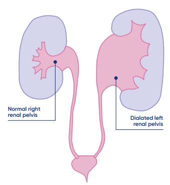 Right Renal Pelvis