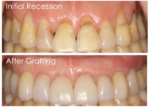 Tissue Grafting with a Multi-Disciplinary Approach | Anderson Periodontal Wellness | Bloomfield ...