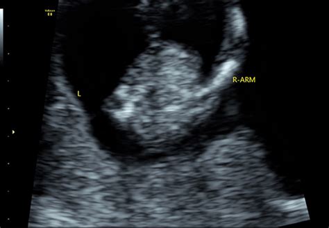 Microphthalmia with limb anomalies with fetal teratoma | IJWH