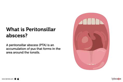 Peritonsillar abscess: Causes, Symptoms, Treatment and Cost