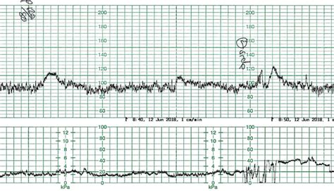 The fetal bradycardia – O&G Magazine