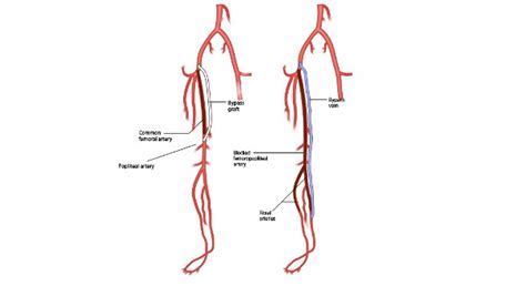 Femoral-Below knee Popliteal Artery Bypass Graft