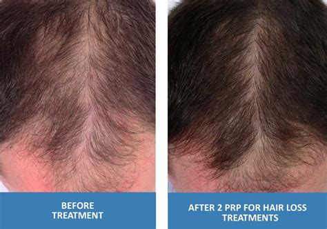 PRP For Hair Loss - Platelet Rich Plasma in Springfield Missouri