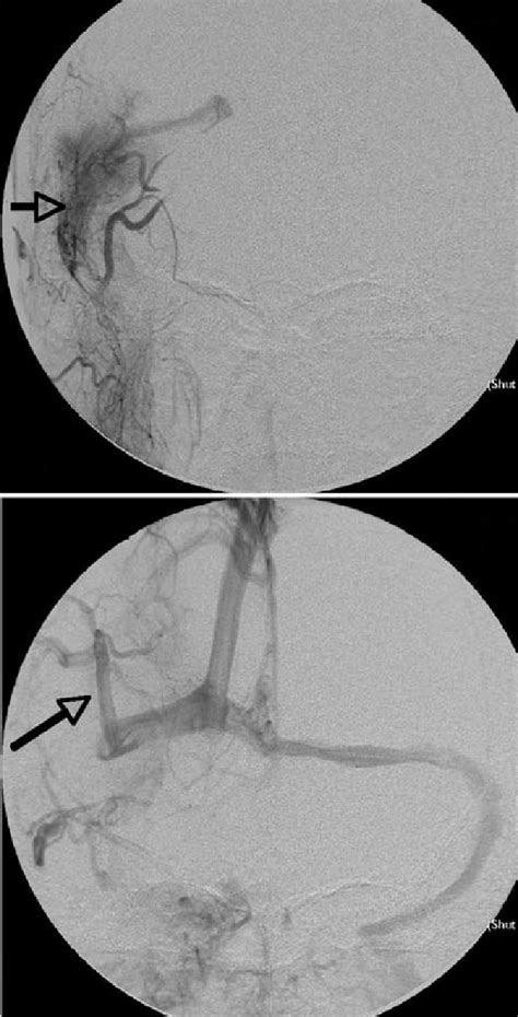 Upper: Cerebral angiogram, early arterial phase, showing a tumor blush... | Download Scientific ...