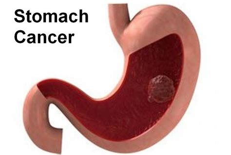 Stomach Cancer: Causes, Symptoms, Diagnosis And Treatment | Health And Beauty