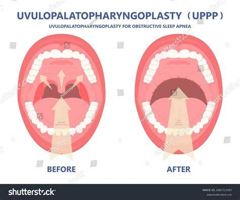 Throat Uvula Surgery