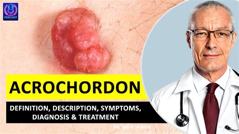 ACROCHORDON. Definition, Description, Causes and symptoms, Diagnosis & Treatment of Acrochordon ...