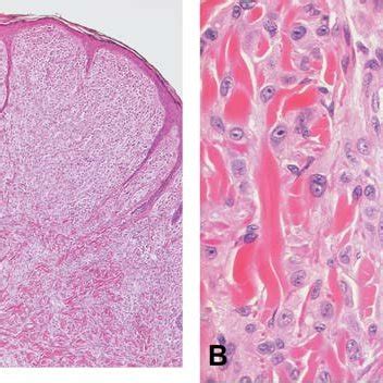 Histology of Spitz nevus. A. Symmetric compound nevus with sharp ...