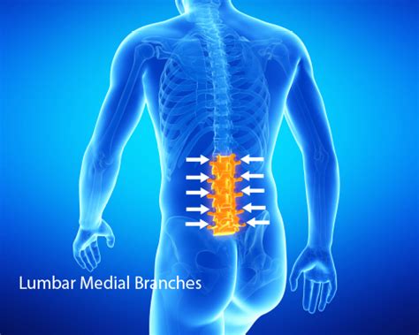 Lumbar Medial Branch Block - Ainsworth Institute