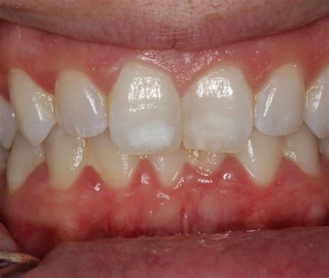 How To Get Rid Of White Spots On Teeth After Braces - TeethWalls