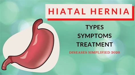 Hiatal Hernia: Types, Symptoms & Treatment - YouTube