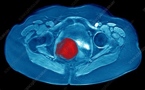 Ovarian cyst, MRI scan - Stock Image - C003/0911 - Science Photo Library