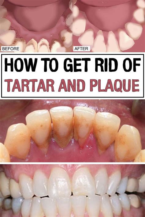 How to get rid of tartar and plaque #dentalplaque | Homemade remedies ...