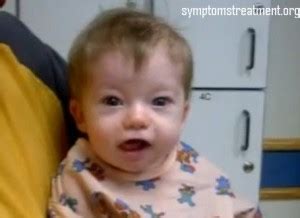 DiGeorge syndrome-Pictures, Syndrome, Treatment, Causes