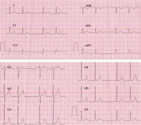 Atrial Fibrillation with Bigeminal Rhythm - All About Heart And Blood Vessels