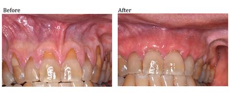 Gingival Graft Alloderm