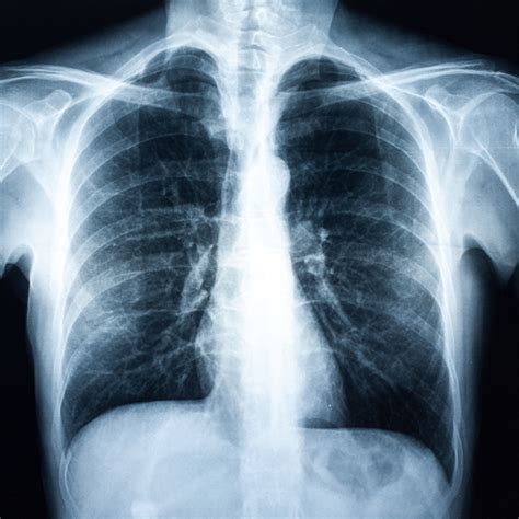 Diagnosis of bronchitis - PARI