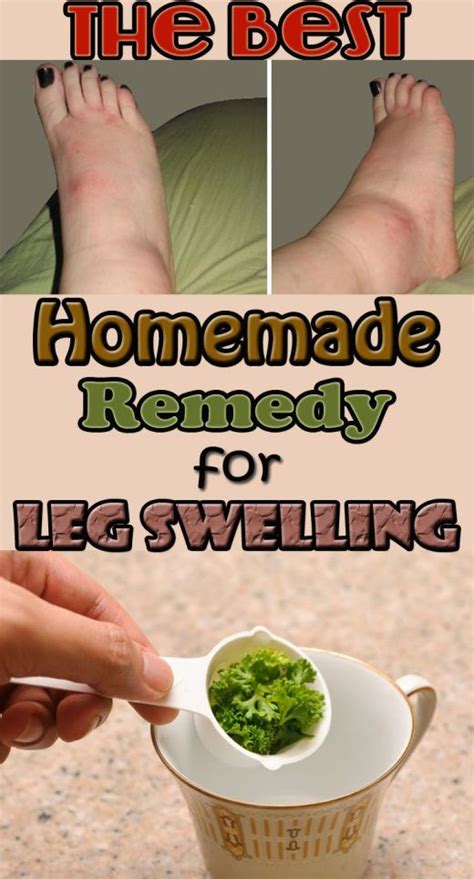 THE BEST HOMEMADE REMEDY FOR LEG SWELLING | Natural health remedies, Health remedies, Swelling ...