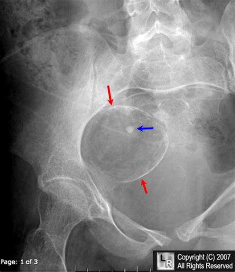 Learning Radiology - Dermoid Cyst, Ovary, Teratoma, rupture, tooth