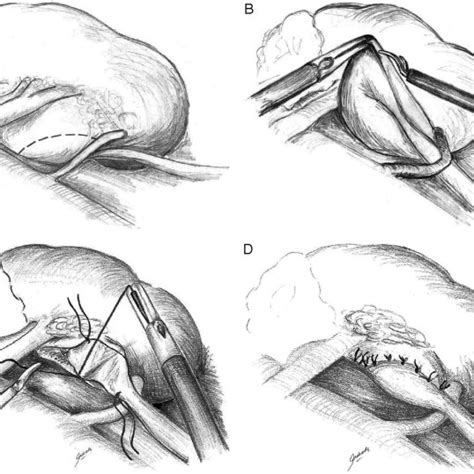 Nephropexy performed to assist drainage with grav- ity. | Download Scientific Diagram