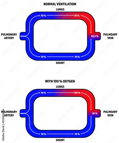 A diagram of how a pulmonary shunt works Stock Vector | Adobe Stock