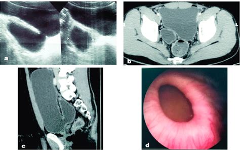 Diverticulum Of Bladder Ultrasound