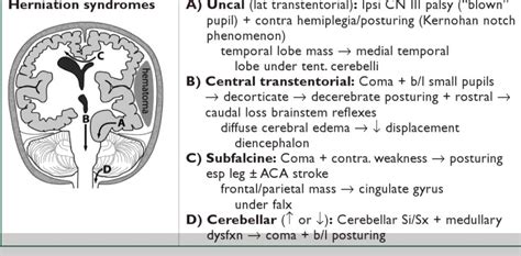 brain herniation syndrome: Uncal herniation: clinical triad of (1) "blown" pupil (2) hemiplegia ...