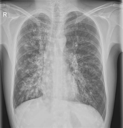 the xray doctor: xrayoftheweek 40: which long term condition is seen here?