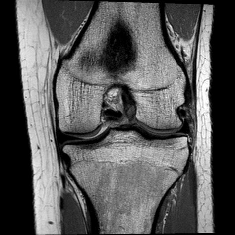 normal knee MRI coronal view 4 Diagram | Quizlet