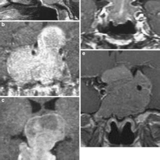 Pre-operative contrasted T1-weighted MRI studies illustrating tumours... | Download Scientific ...