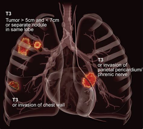 Pet Scan Images Lung Cancer