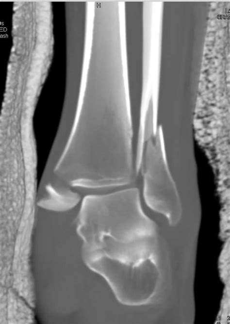 Distal Fibula Fracture