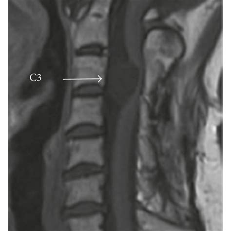 Magnetic resonance imaging (MRI) showing the intradural extramedullary... | Download Scientific ...