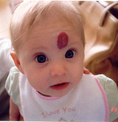 Hemangioma | About Hemangioma, Definition, Symptoms and Treatments