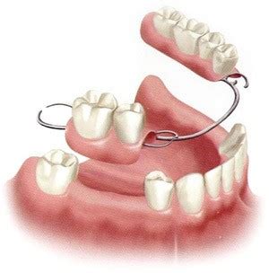 Dental Flipper Teeth: Cost & Benefits