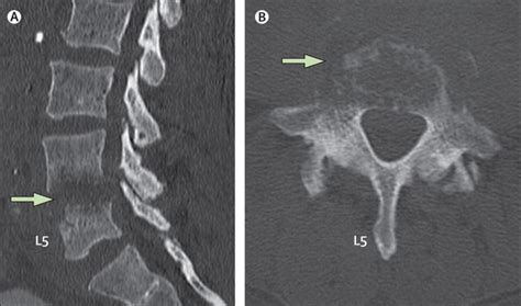 Vertebral Osteomyelitis – Core EM