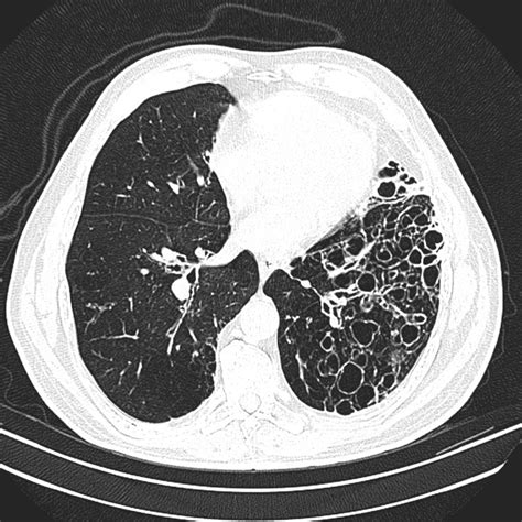 cystic-bronchiectasis-3 – PinkyBone